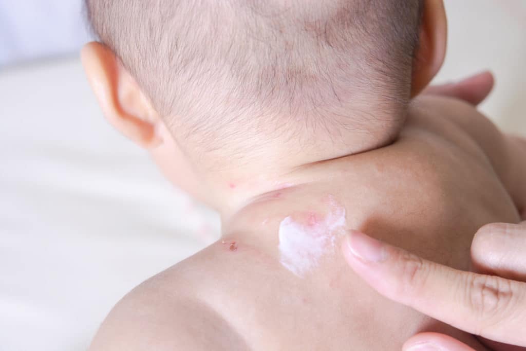 Mückenschutz für Babys